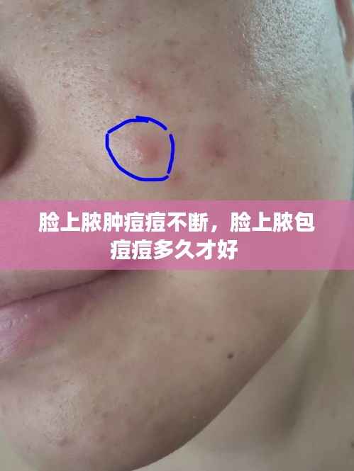 脸上脓肿痘痘不断,脸上脓包痘痘多久才好