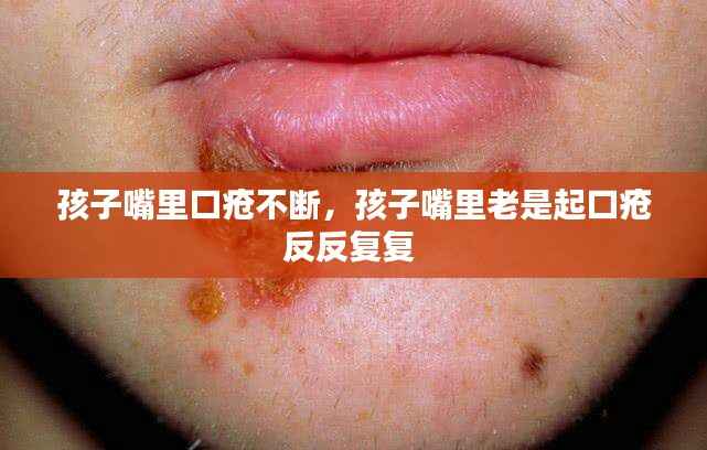 孩子嘴里口疮不断,孩子嘴里老是起口疮反反复复